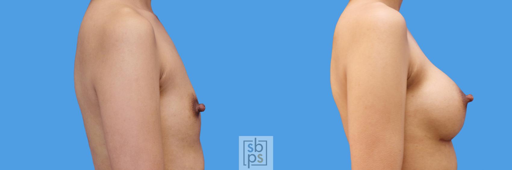 Before & After Breast Augmentation Case 240 View #3 View in Torrance & Los Angeles, CA, CA