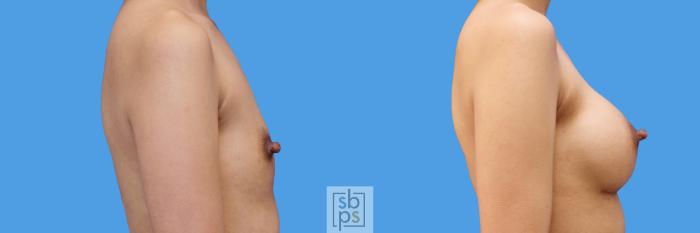 Before & After Breast Augmentation Case 240 View #3 View in Torrance, CA