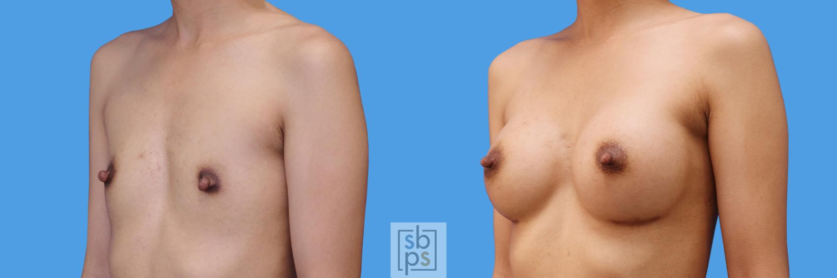 Before & After Breast Augmentation Case 240 View #4 View in Torrance & Los Angeles, CA, CA