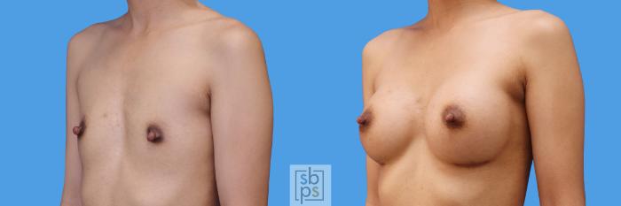 Before & After Breast Augmentation Case 240 View #4 View in Torrance, CA