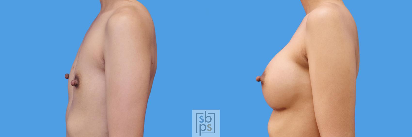 Before & After Breast Augmentation Case 240 View #5 View in Torrance & Los Angeles, CA, CA