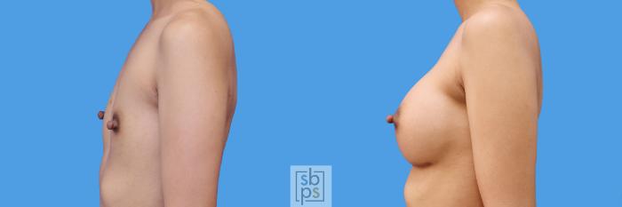 Before & After Breast Augmentation Case 240 View #5 View in Torrance, CA