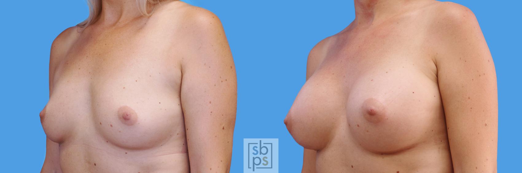 Before & After Breast Augmentation Case 242 View #1 View in Torrance, CA
