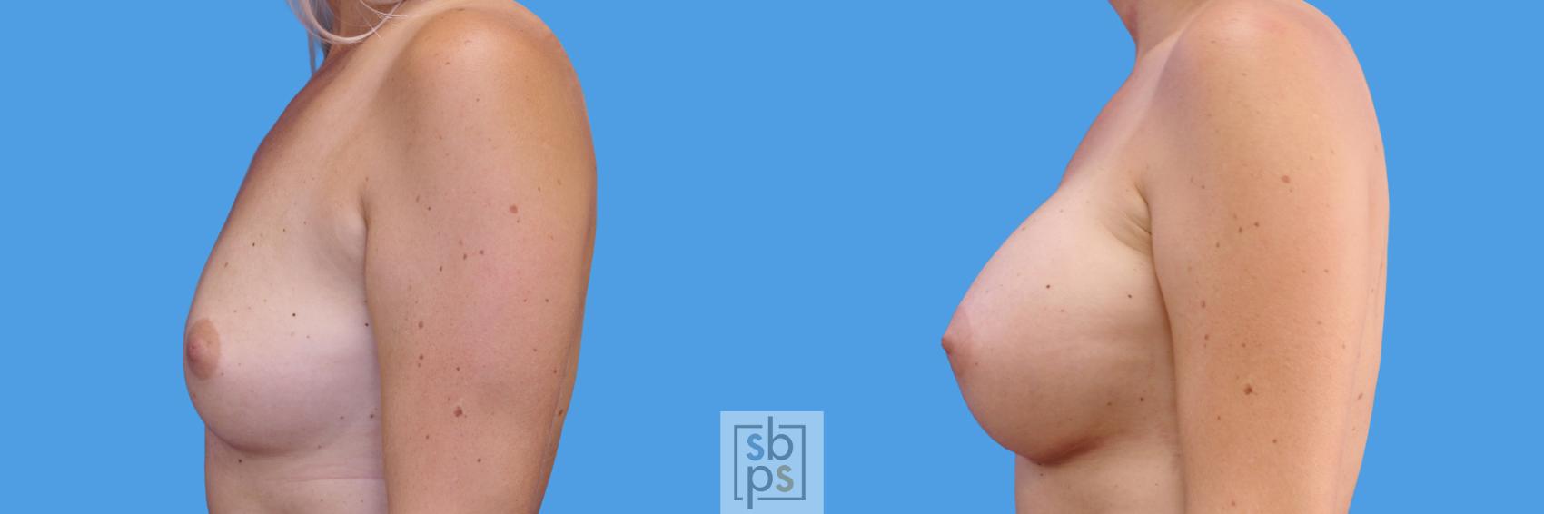 Before & After Breast Augmentation Case 242 View #2 View in Torrance, CA