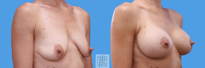 Before & After Breast Lift Case 249 View #2 View in Torrance, CA