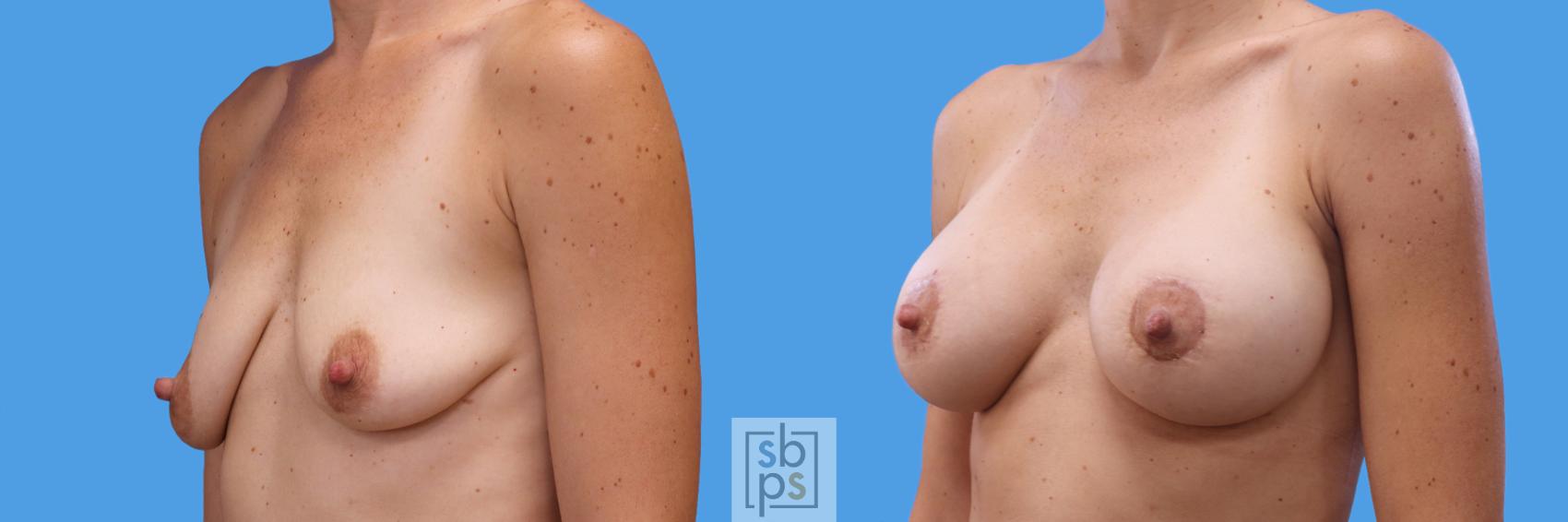 Before & After Breast Augmentation Case 249 View #3 View in Torrance, CA