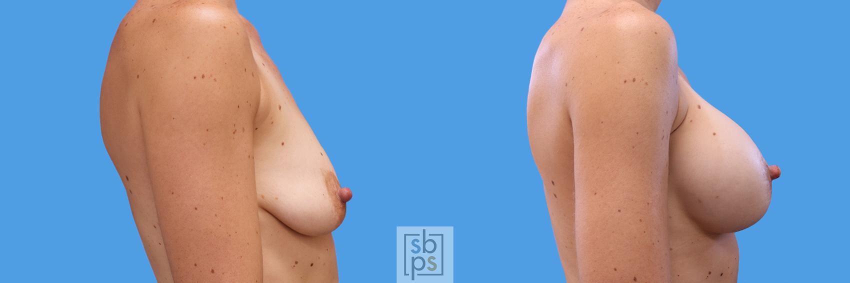 Before & After Breast Augmentation Case 249 View #4 View in Torrance, CA