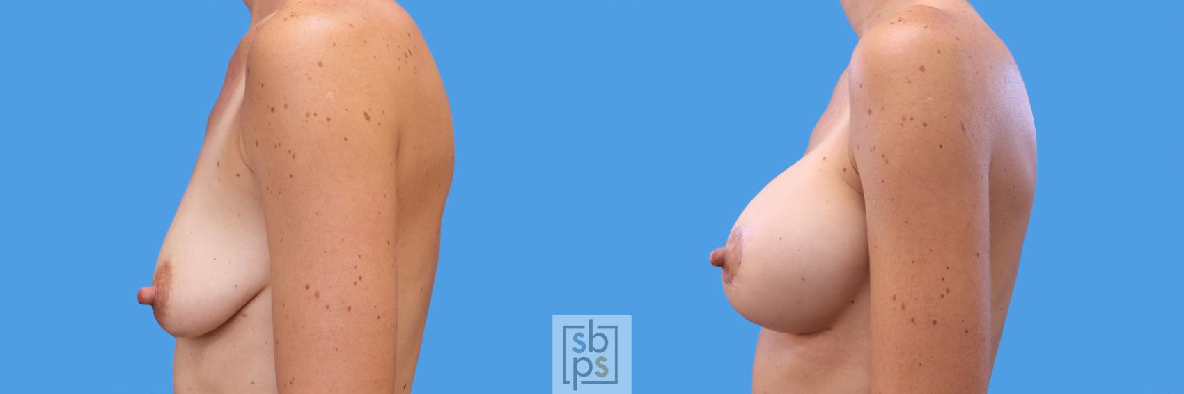 Before & After Breast Augmentation Case 249 View #5 View in Torrance, CA