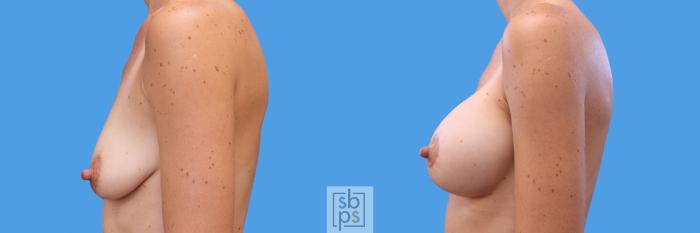 Before & After Breast Lift Case 249 View #5 View in Torrance, CA