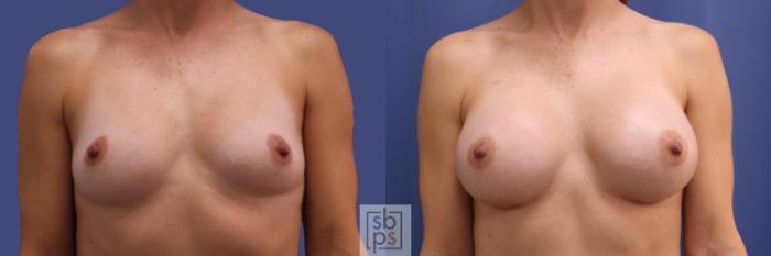 Before & After Breast Augmentation Case 250 View #1 View in Torrance, CA