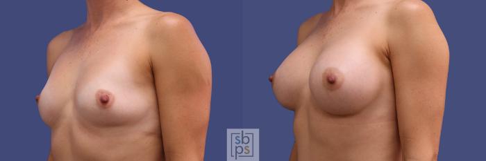 Before & After Breast Augmentation Case 250 View #2 View in Torrance, CA