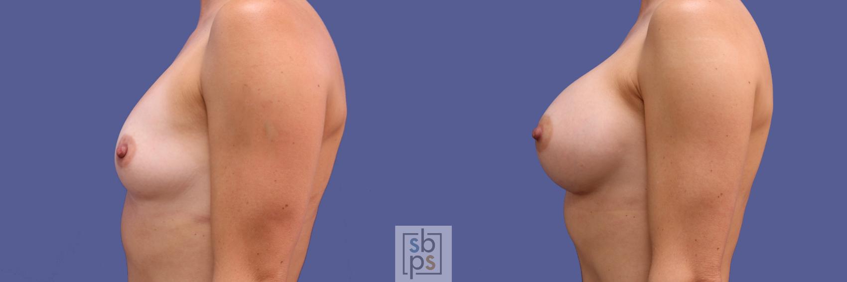 Before & After Breast Augmentation Case 250 View #3 View in Torrance, CA