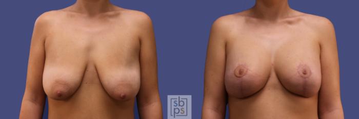 Before & After Breast Augmentation Case 252 View #1 View in Torrance, CA