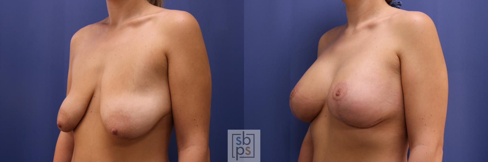 Before & After Breast Augmentation Case 252 View #2 View in Torrance & Los Angeles, CA, CA