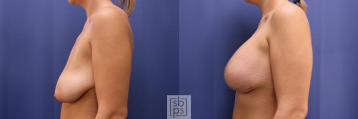 Before & After Breast Augmentation Case 252 View #3 View in Torrance, CA