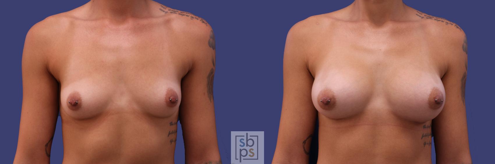 Before & After Breast Augmentation Case 255 View #1 View in Torrance, CA
