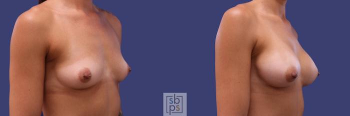 Before & After Breast Augmentation Case 255 View #2 View in Torrance, CA