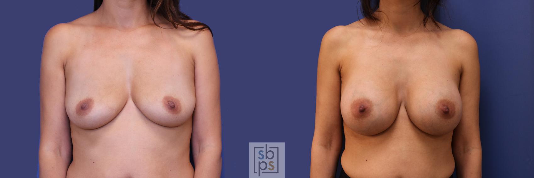 Before & After Breast Augmentation Case 257 View #1 View in Torrance, CA