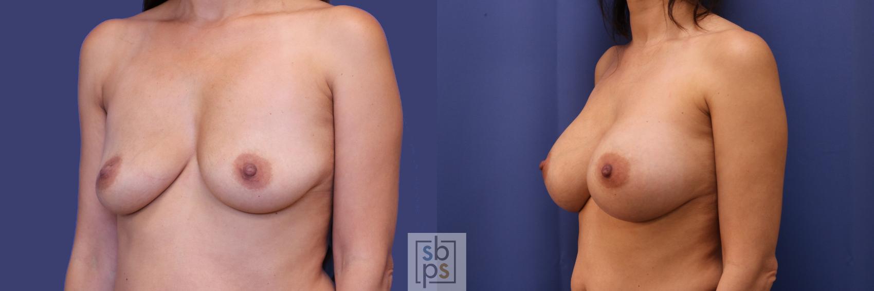 Before & After Breast Augmentation Case 257 View #2 View in Torrance & Los Angeles, CA, CA