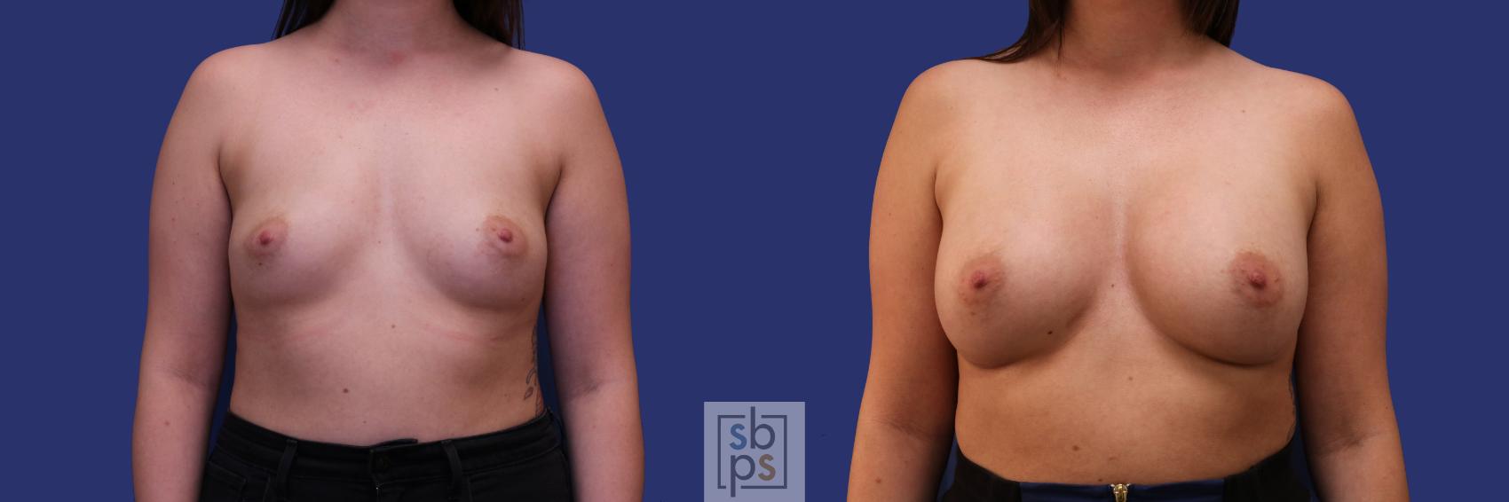 Before & After Breast Augmentation Case 260 View #1 View in Torrance, CA