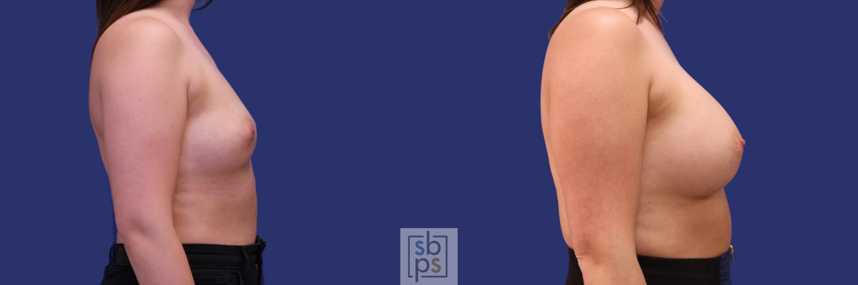 Before & After Breast Augmentation Case 260 View #3 View in Torrance & Los Angeles, CA, CA