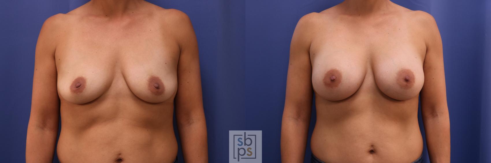 Before & After Breast Augmentation Case 262 View #1 View in Torrance, CA