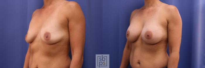 Before & After Breast Augmentation Case 262 View #2 View in Torrance, CA