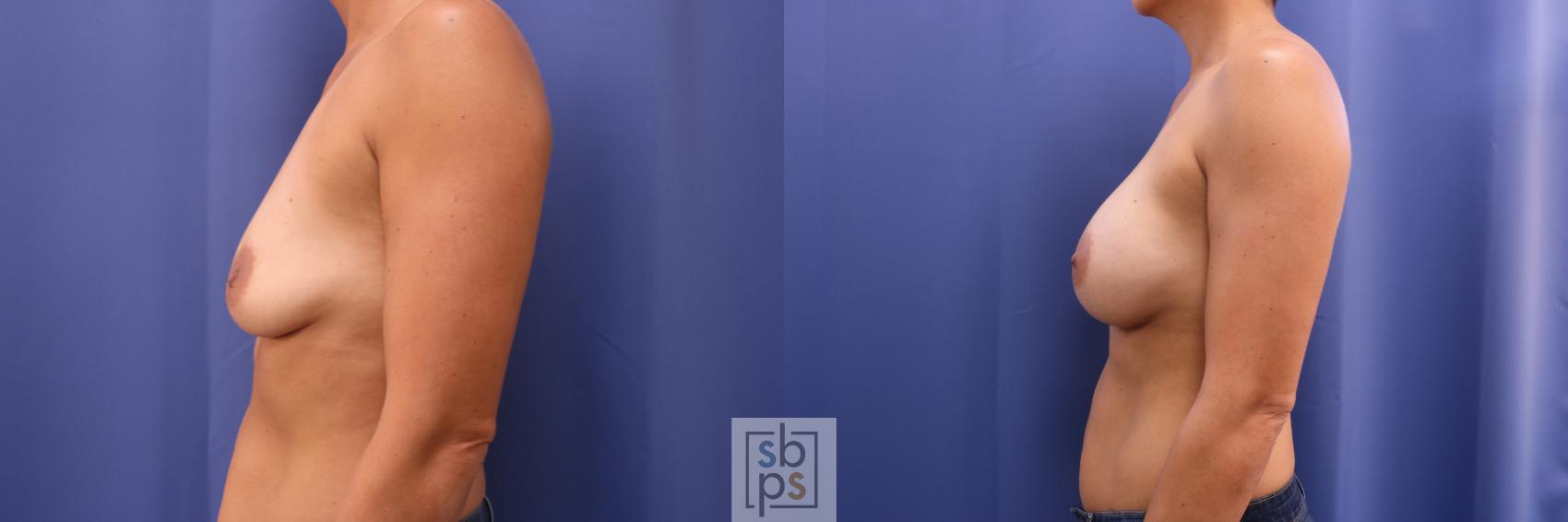 Before & After Breast Augmentation Case 262 View #3 View in Torrance, CA