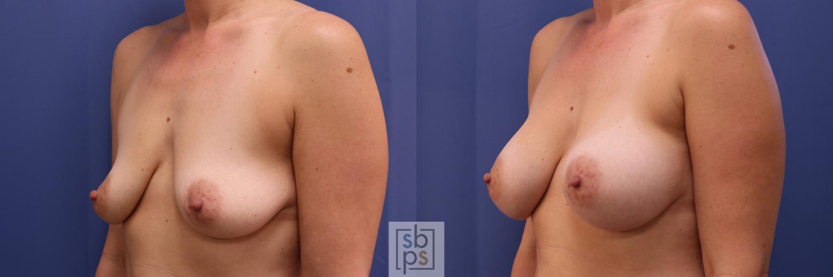 Before & After Breast Augmentation Case 274 View #4 View in Los Angeles & Torrance, CA, CA