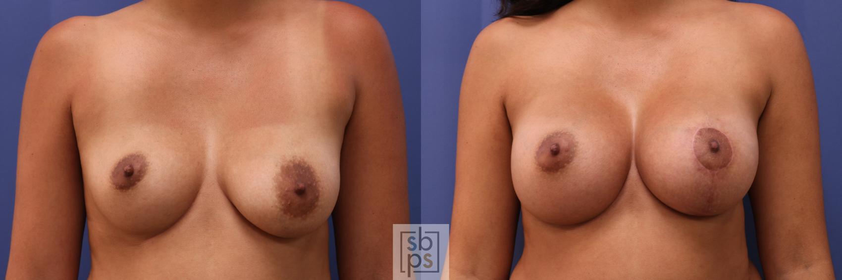 Before & After Breast Lift Case 276 View #1 View in Torrance, CA