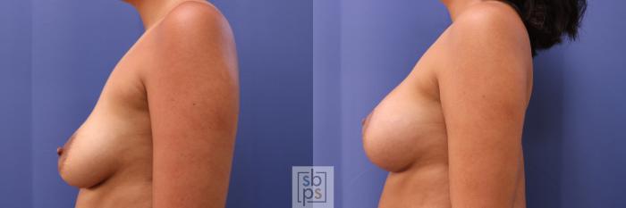 Before & After Breast Lift Case 276 View #2 View in Torrance, CA