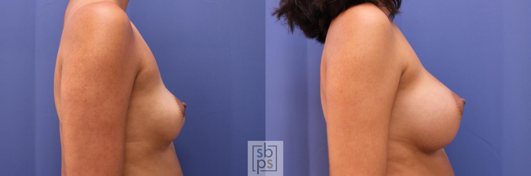 Before & After Breast Augmentation Case 276 View #4 View in Los Angeles, Torrance & Long Beach, CA