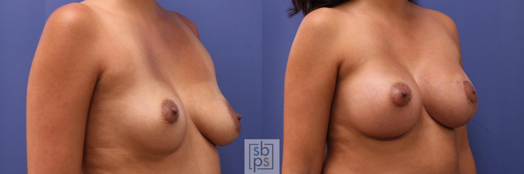 Before & After Breast Augmentation Case 276 View #5 View in Los Angeles, Torrance & Long Beach, CA