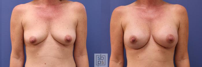 Before & After Breast Augmentation Case 281 View #1 View in Torrance, CA