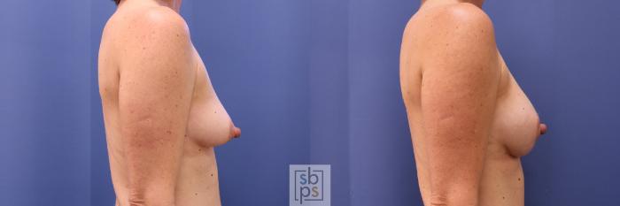 Before & After Breast Augmentation Case 281 View #4 View in Torrance, CA