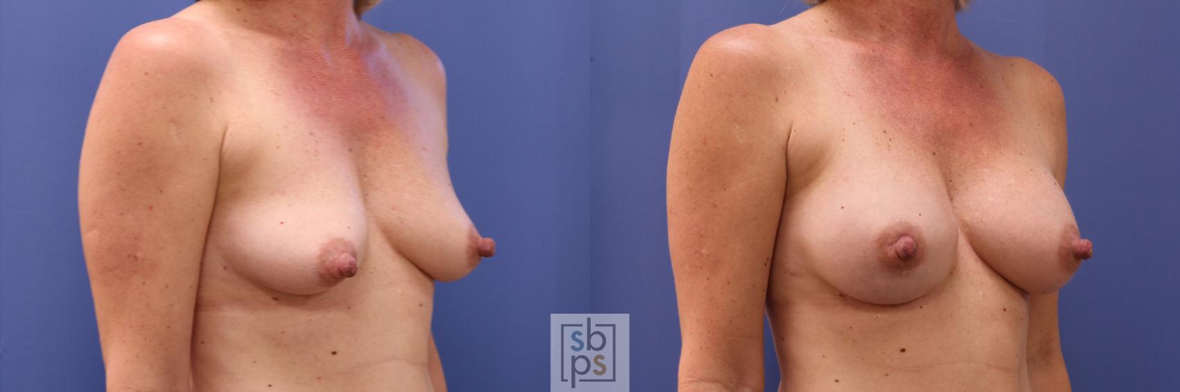 Before & After Breast Augmentation Case 281 View #5 View in Torrance & Los Angeles, CA, CA