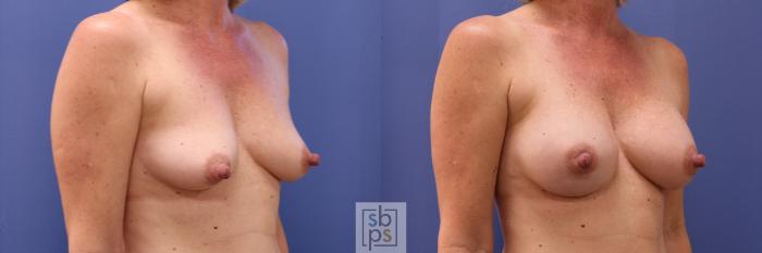 Before & After Breast Augmentation Case 281 View #5 View in Torrance, CA