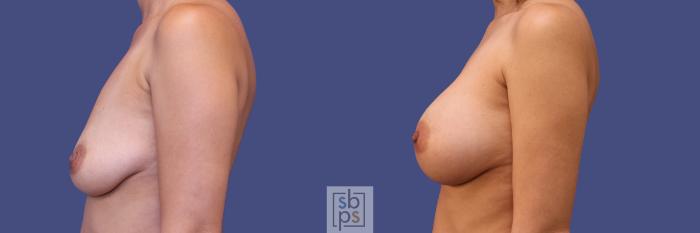Before & After Breast Augmentation Case 283 View #2 View in Torrance, CA
