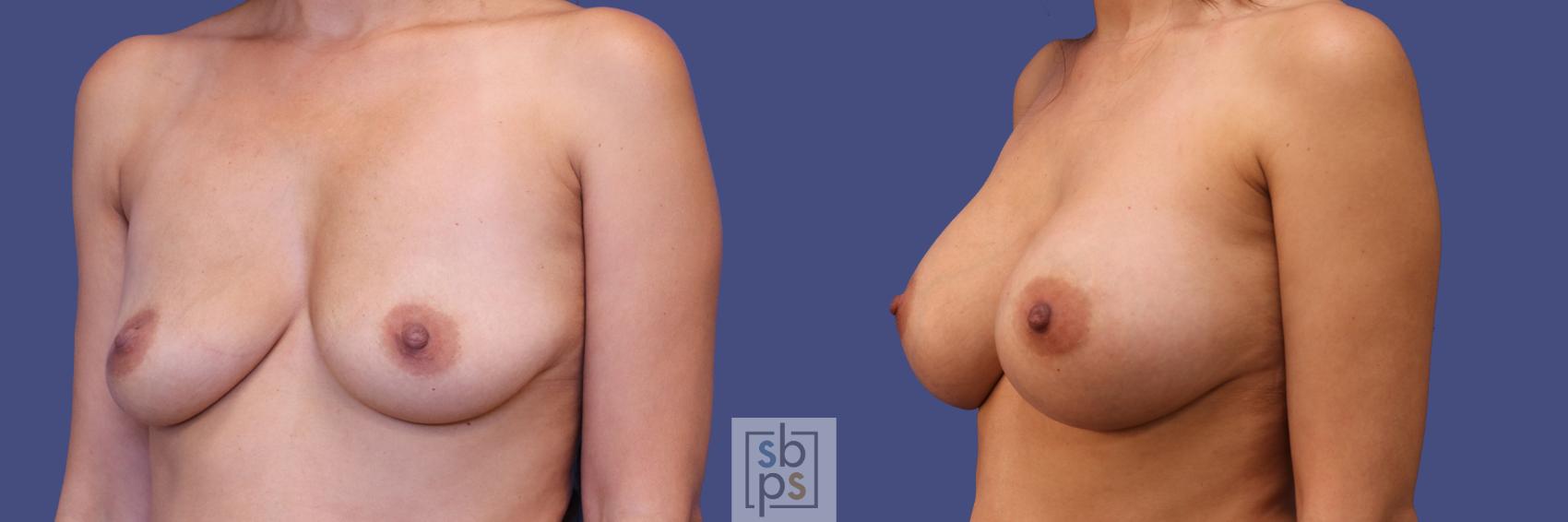 Before & After Breast Augmentation Case 283 View #3 View in Torrance & Los Angeles, CA, CA