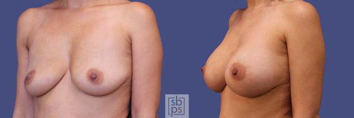 Before & After Breast Augmentation Case 283 View #3 View in Torrance, CA