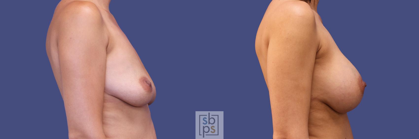 Before & After Breast Augmentation Case 283 View #4 View in Torrance & Los Angeles, CA, CA