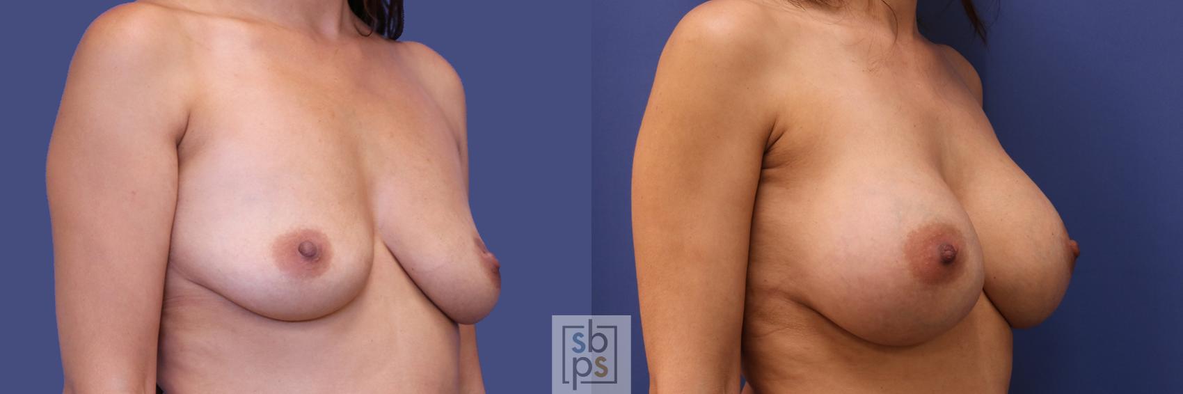 Before & After Breast Augmentation Case 283 View #5 View in Torrance & Los Angeles, CA, CA