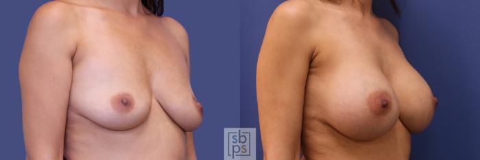 Before & After Breast Augmentation Case 283 View #5 View in Torrance, CA