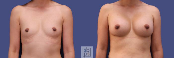 Before & After Breast Augmentation Case 288 View #1 View in Torrance, CA