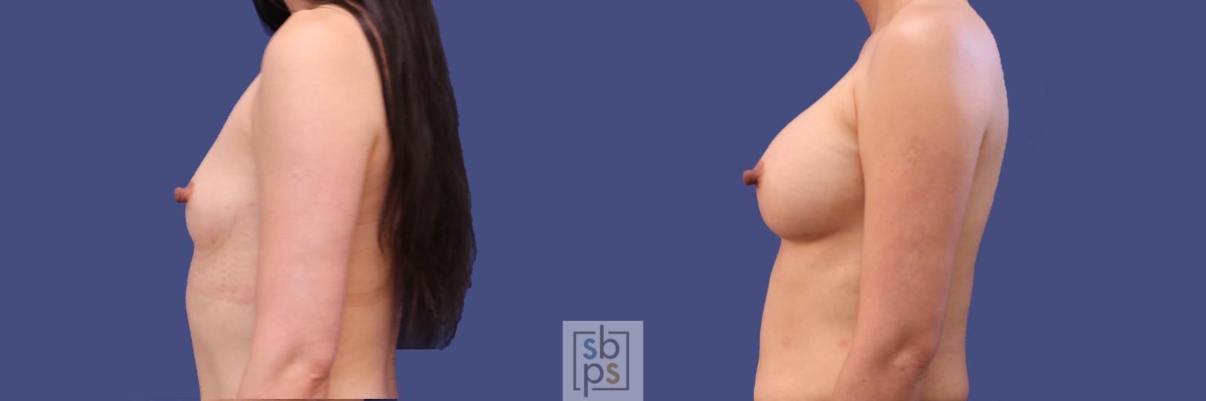 Before & After Breast Augmentation Case 288 View #2 View in Torrance & Los Angeles, CA, CA