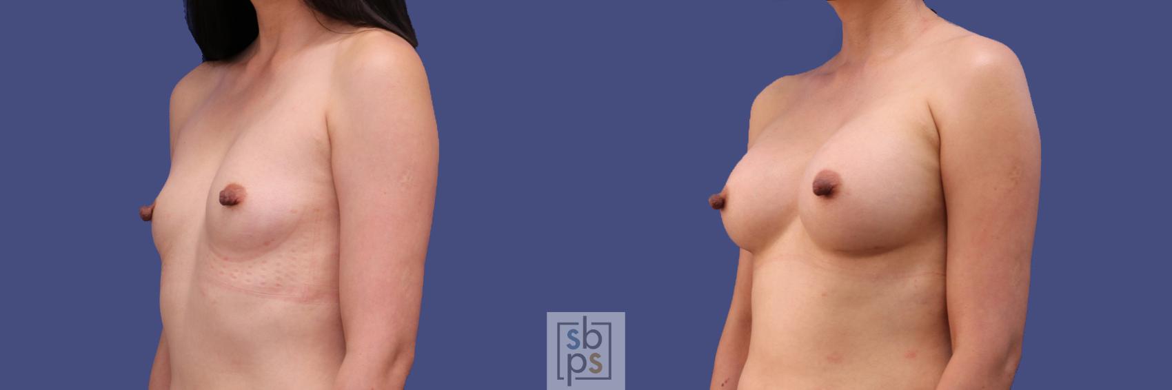 Before & After Breast Augmentation Case 288 View #3 View in Torrance & Los Angeles, CA, CA