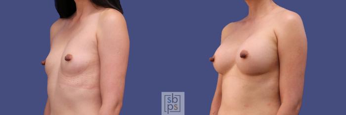 Before & After Breast Augmentation Case 288 View #3 View in Torrance, CA
