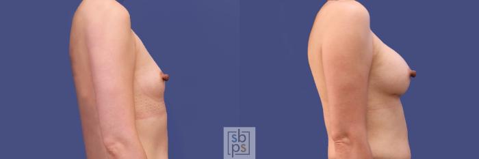 Before & After Breast Augmentation Case 288 View #4 View in Torrance, CA