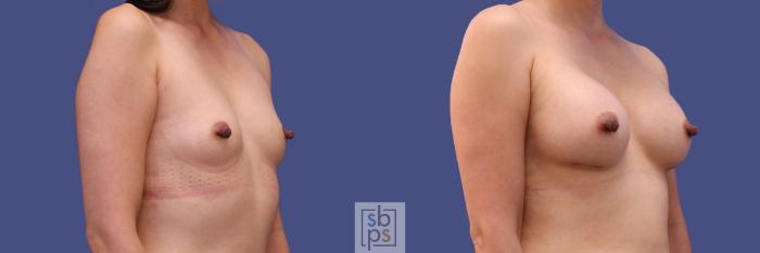 Before & After Breast Augmentation Case 288 View #5 View in Torrance, CA