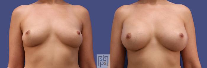 Before & After Breast Augmentation Case 294 View #1 View in Torrance, CA
